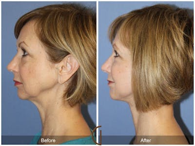 Facelift 50s Before & After Gallery - Patient 240796 - Image 1