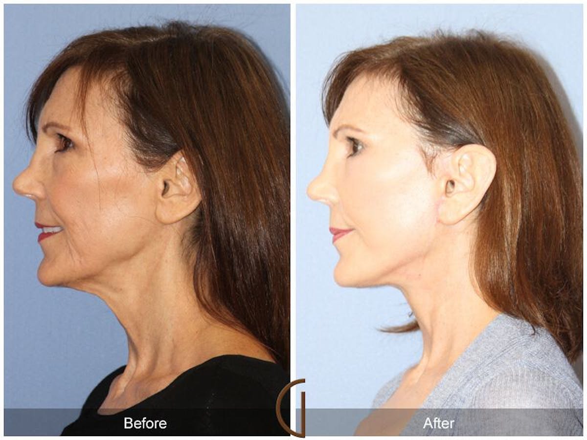 Facelift 50s Before & After Gallery - Patient 218675 - Image 1