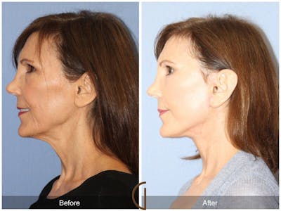 Facelift 50s Before & After Gallery - Patient 218675 - Image 1