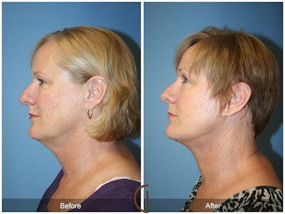 Facelift 50s Before & After Gallery - Patient 278242 - Image 1