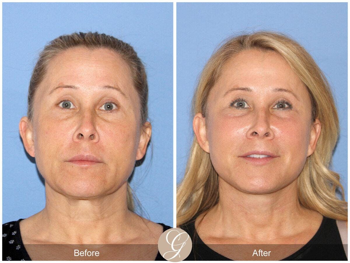 Facelift 50s Before & After Gallery - Patient 108677 - Image 2