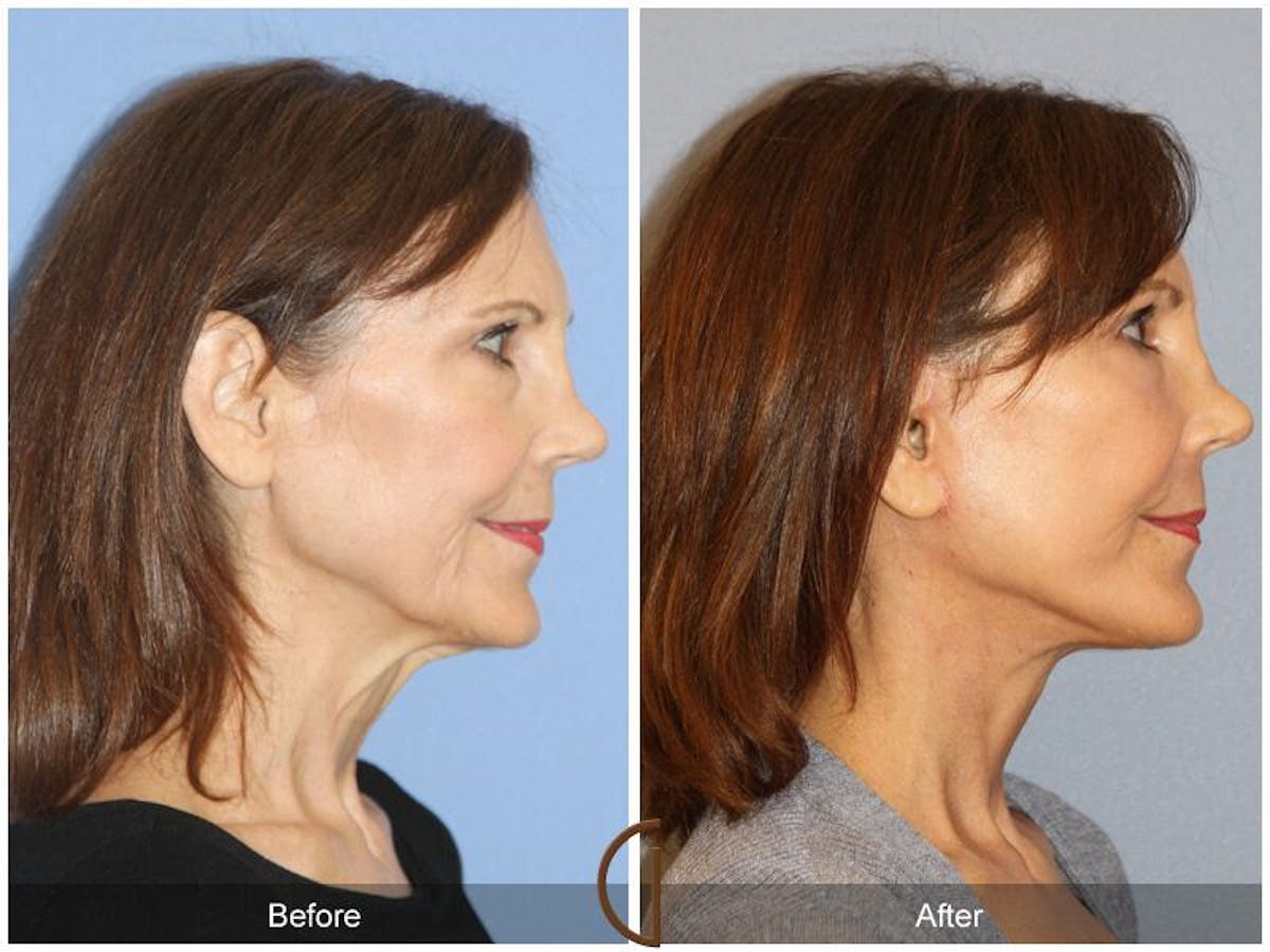 Facelift 50s Before & After Gallery - Patient 218675 - Image 3