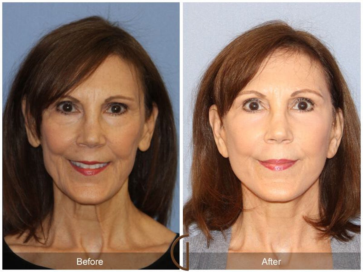 Facelift 50s Before & After Gallery - Patient 218675 - Image 2