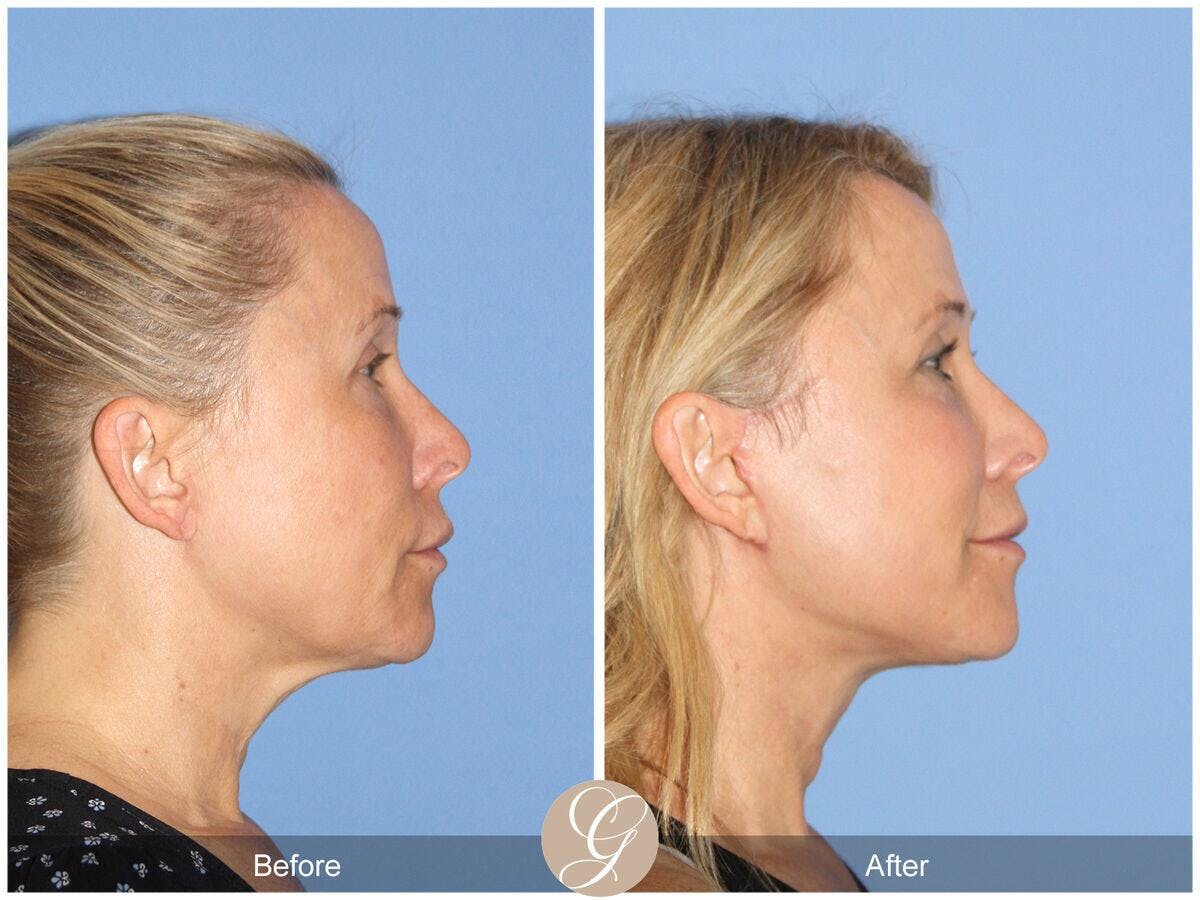 Facelift 50s Before & After Gallery - Patient 108677 - Image 3