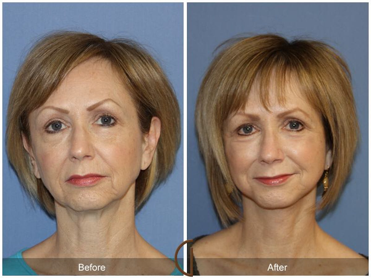 Facelift 50s Before & After Gallery - Patient 240796 - Image 2