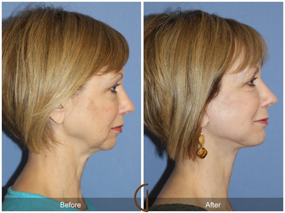 Facelift 50s Before & After Gallery - Patient 240796 - Image 3
