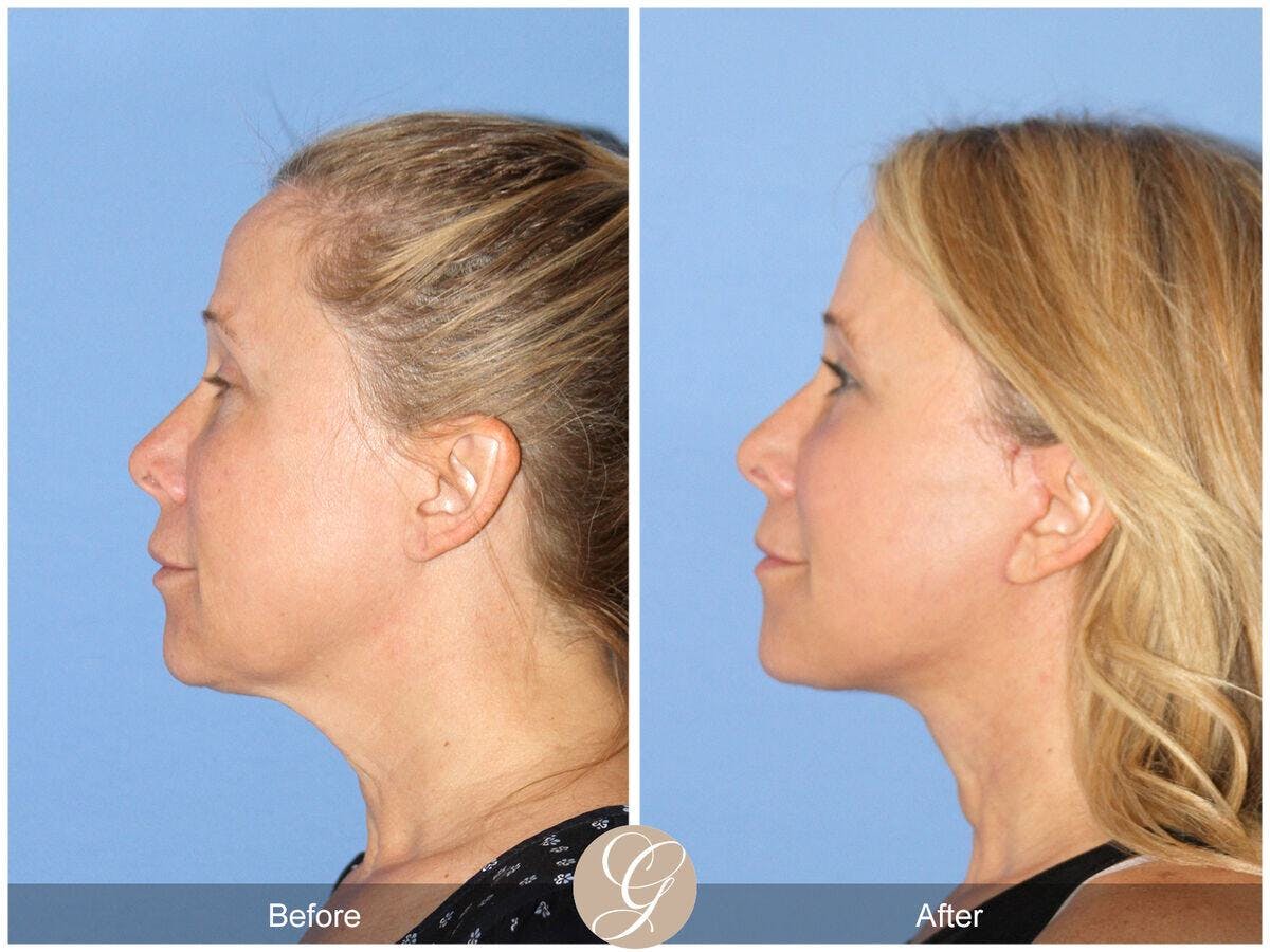 Facelift 50s Before & After Gallery - Patient 108677 - Image 1