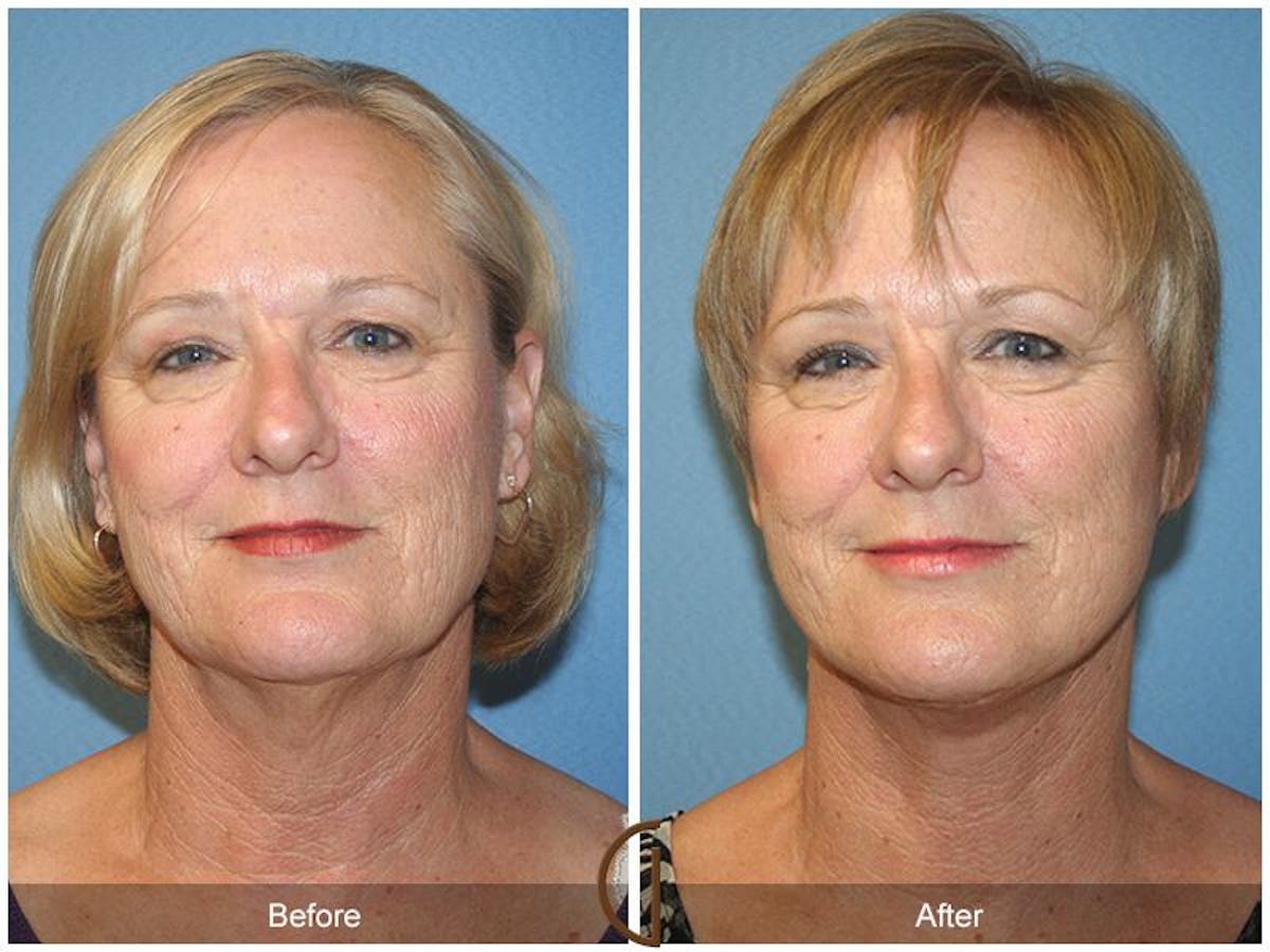 Facelift 50s Before & After Gallery - Patient 278242 - Image 2