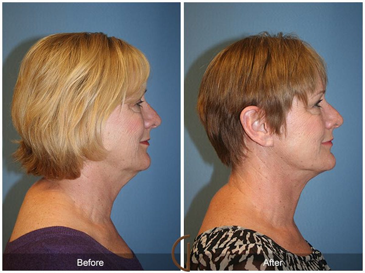 Facelift 50s Before & After Gallery - Patient 278242 - Image 3