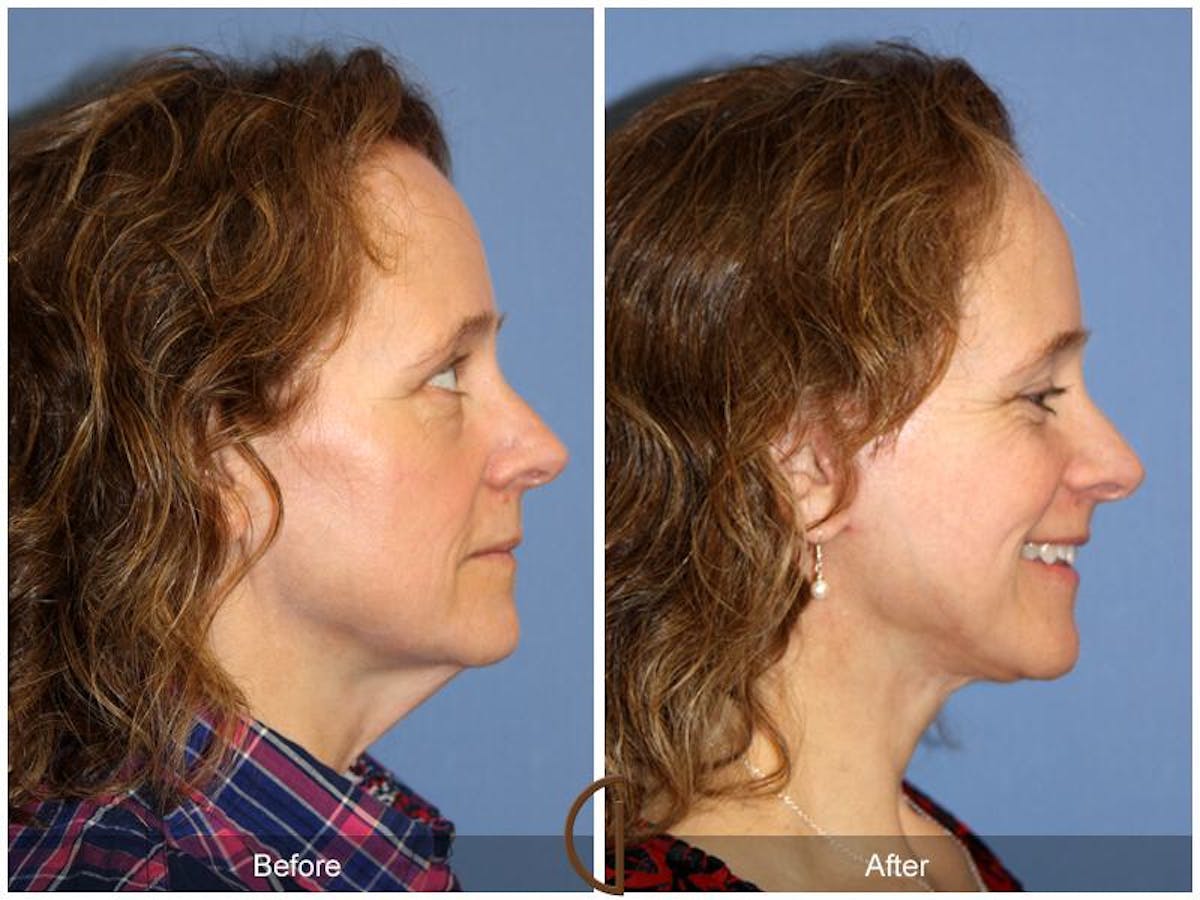 Facelift 50s Before & After Gallery - Patient 262830 - Image 3