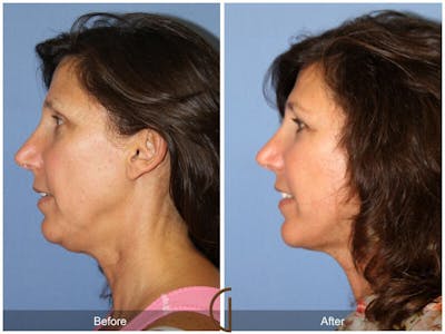 Facelift 50s Before & After Gallery - Patient 669256 - Image 1
