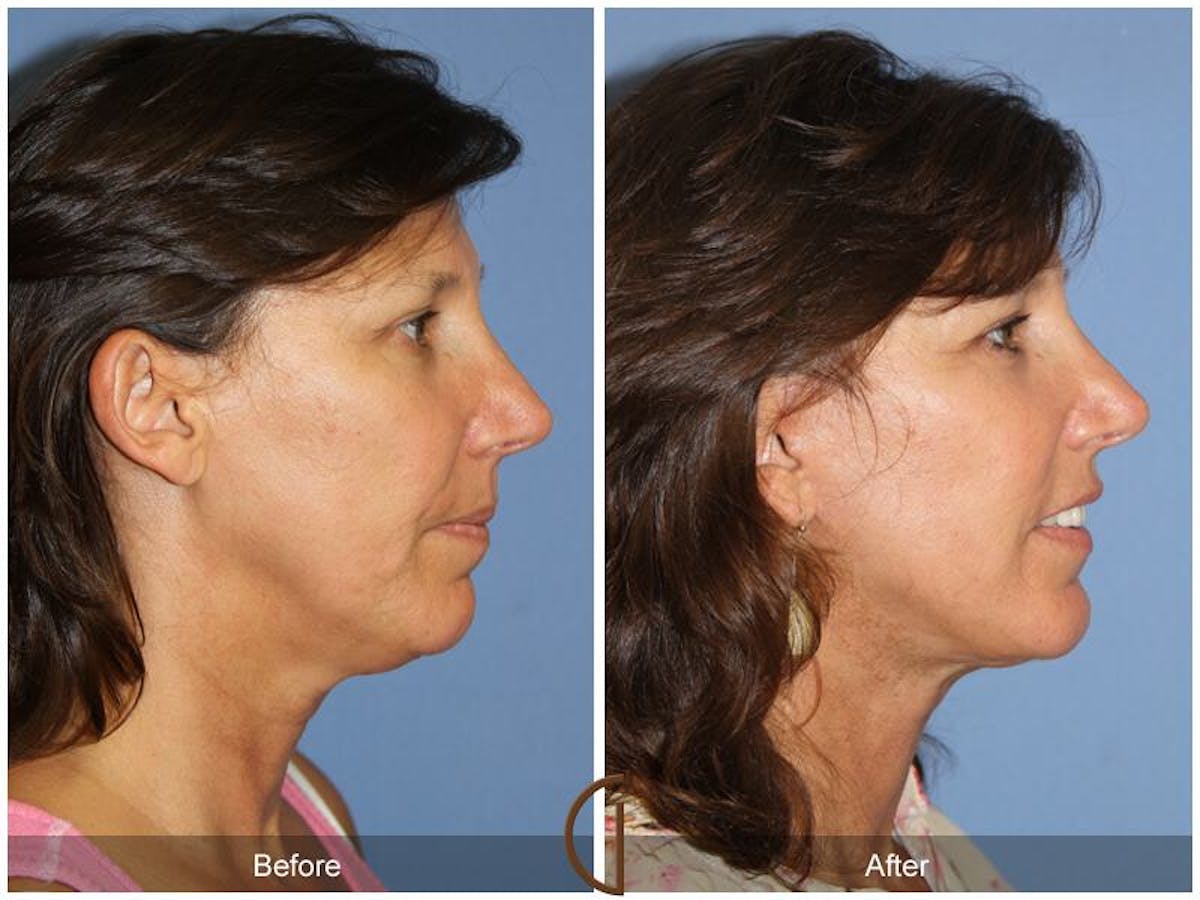Facelift 50s Before & After Gallery - Patient 669256 - Image 3