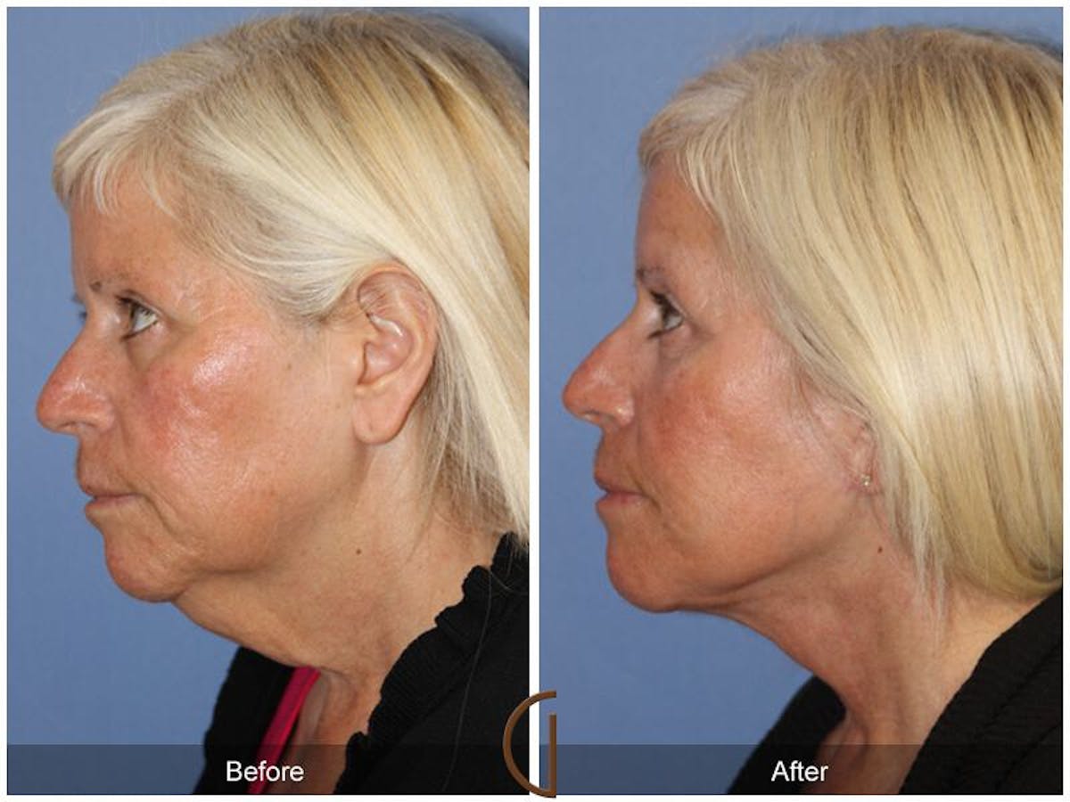 Facelift 50s Before & After Gallery - Patient 410895 - Image 1