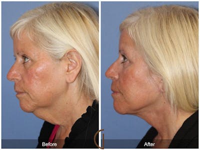 Facelift 50s Before & After Gallery - Patient 410895 - Image 1