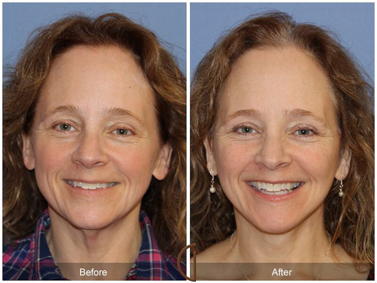 Facelift 50s Before & After Gallery - Patient 262830 - Image 2