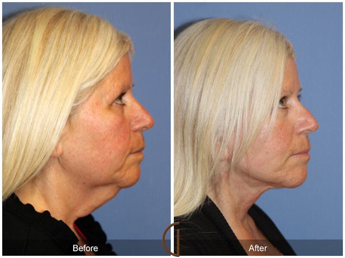Facelift 50s Before & After Gallery - Patient 410895 - Image 3