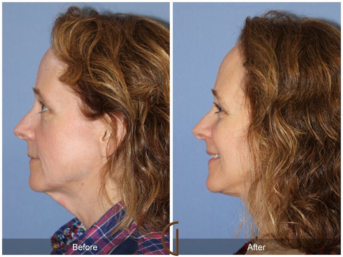 Facelift 50s Before & After Gallery - Patient 262830 - Image 1