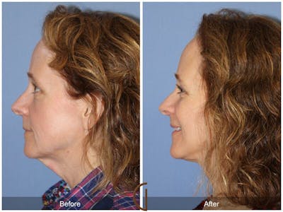 Facelift 50s Before & After Gallery - Patient 262830 - Image 1