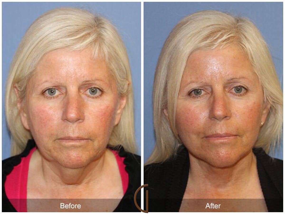 Facelift 50s Before & After Gallery - Patient 410895 - Image 2