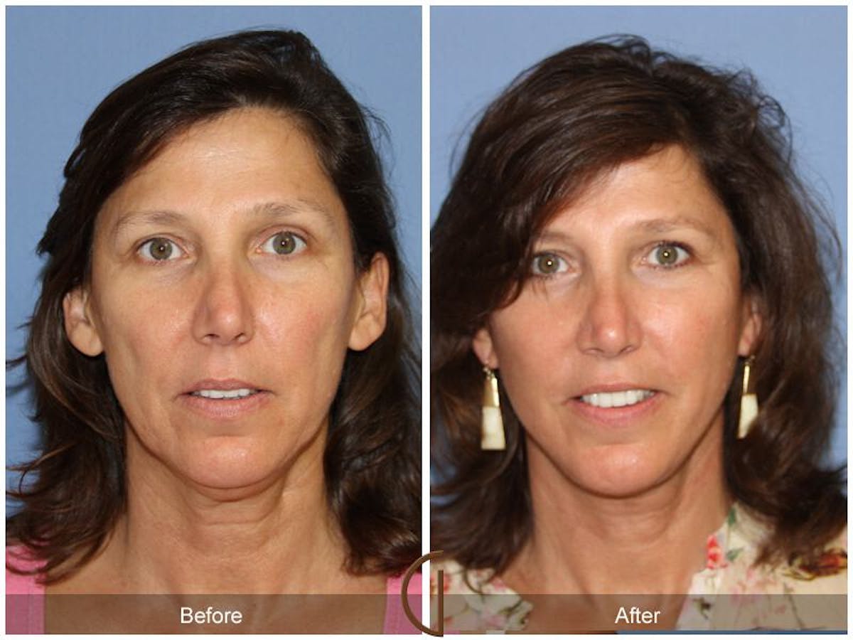 Facelift 50s Before & After Gallery - Patient 669256 - Image 2