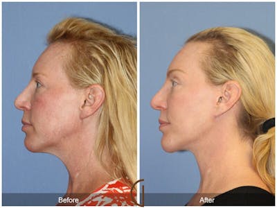 Facelift 40s Before & After Gallery - Patient 295568 - Image 1