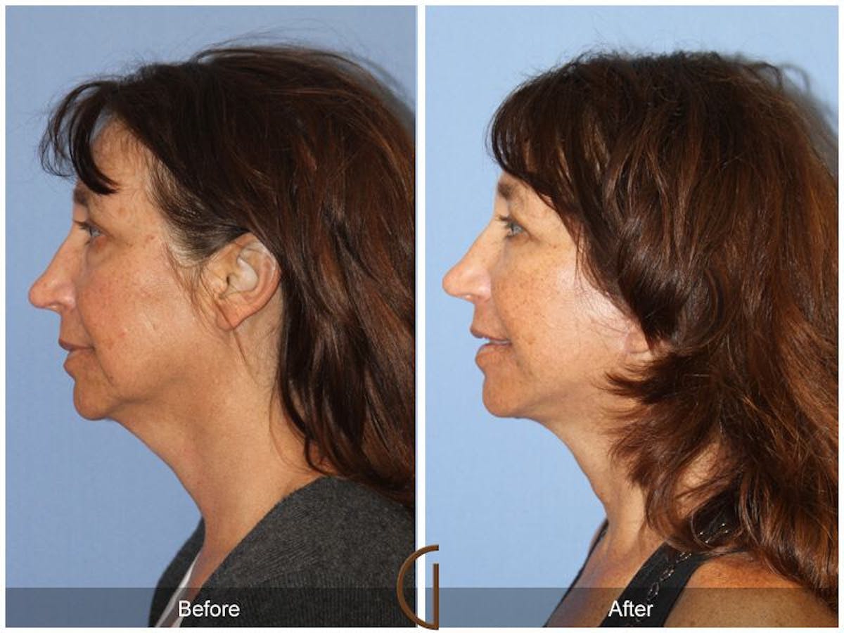 Facelift 40s Before & After Gallery - Patient 681278 - Image 1