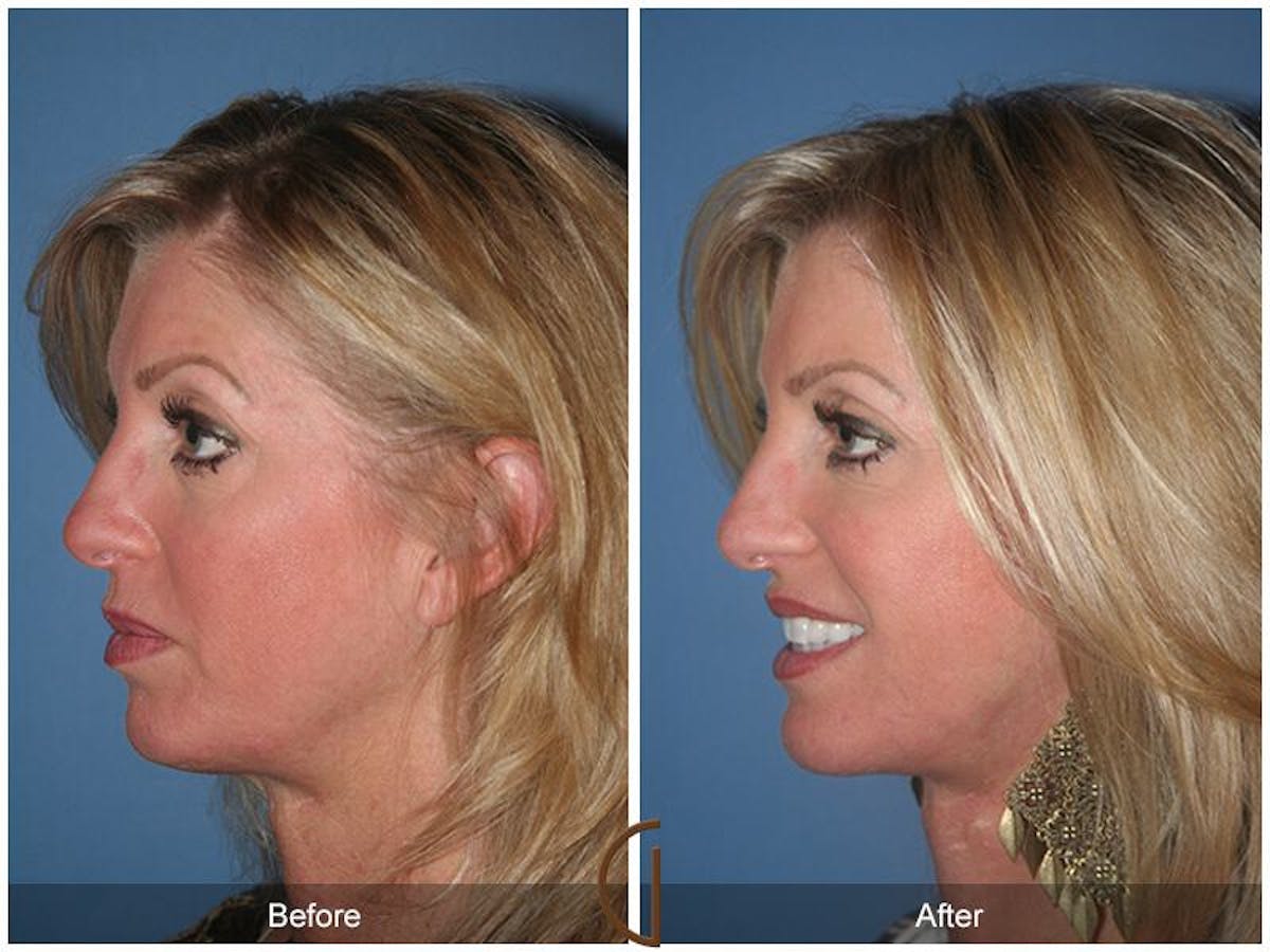 Facelift 40s Before & After Gallery - Patient 282750 - Image 1