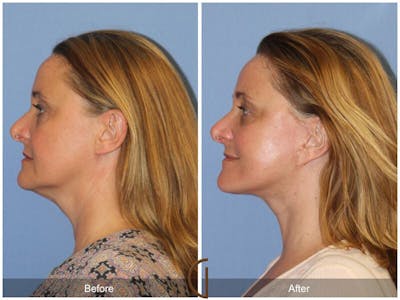 Facelift 40s Before & After Gallery - Patient 315879 - Image 1