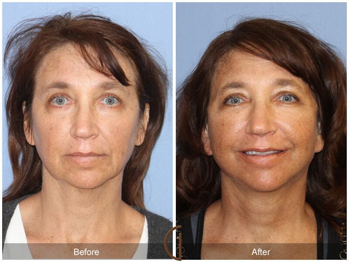 Facelift 40s Before & After Gallery - Patient 681278 - Image 2