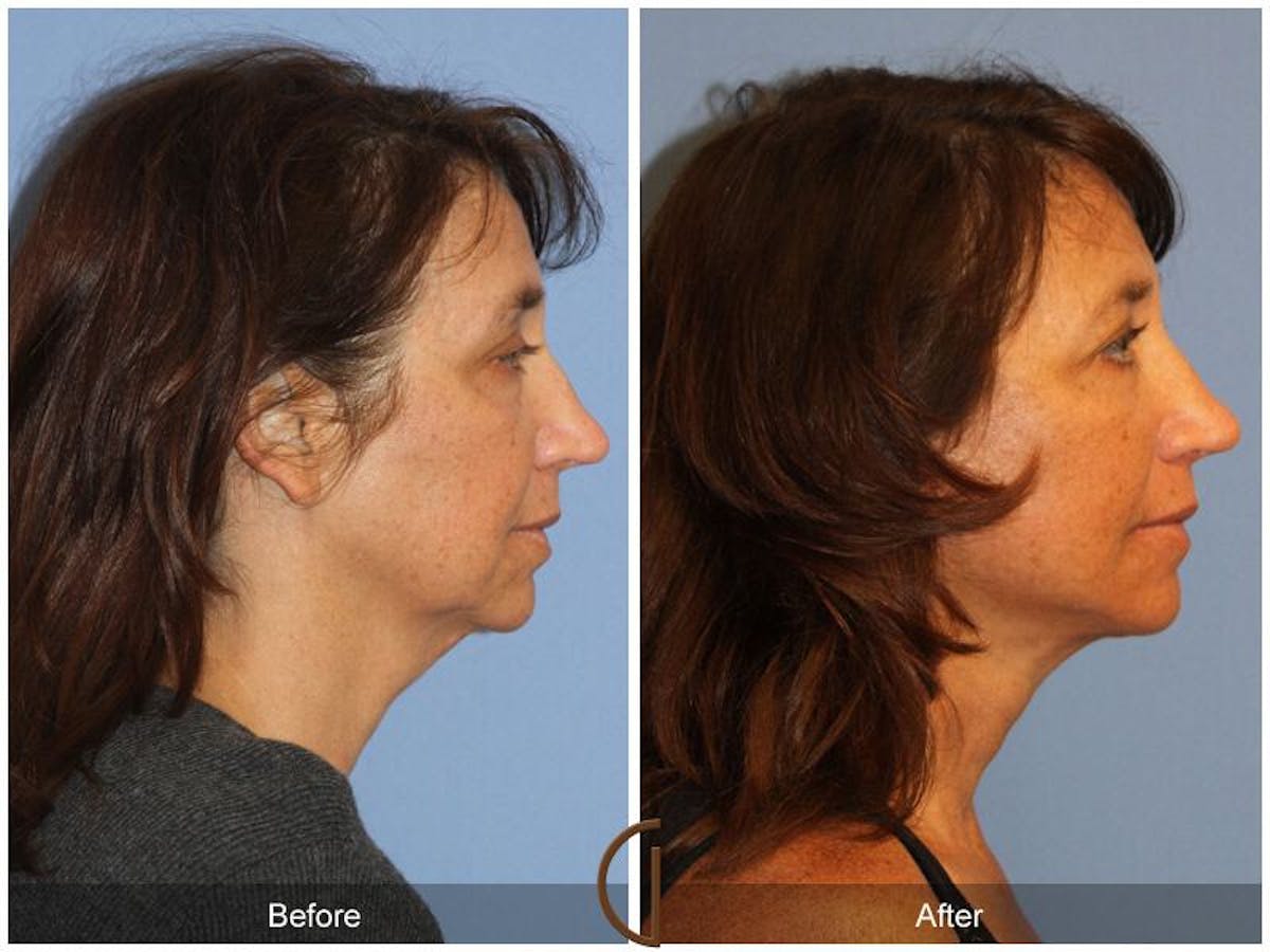 Facelift 40s Before & After Gallery - Patient 681278 - Image 3