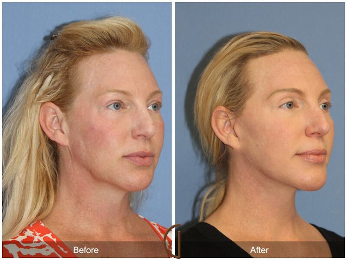 Facelift 40s Before & After Gallery - Patient 295568 - Image 3