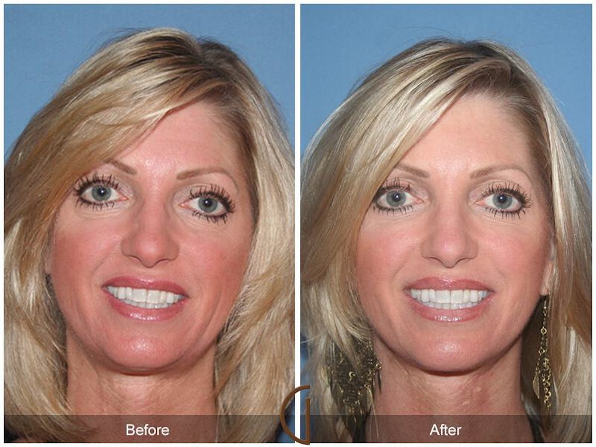 Facelift 40s Before & After Gallery - Patient 282750 - Image 2