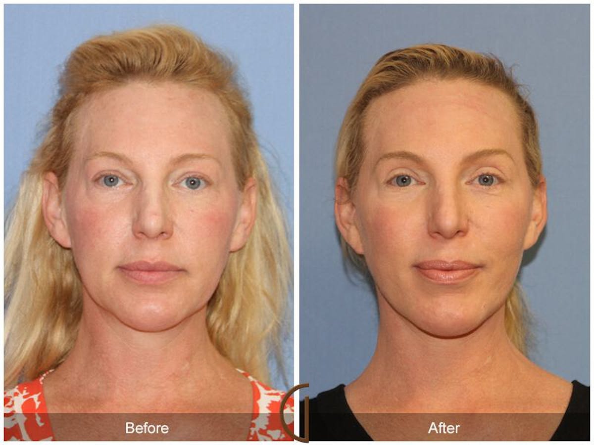 Facelift 40s Before & After Gallery - Patient 295568 - Image 2