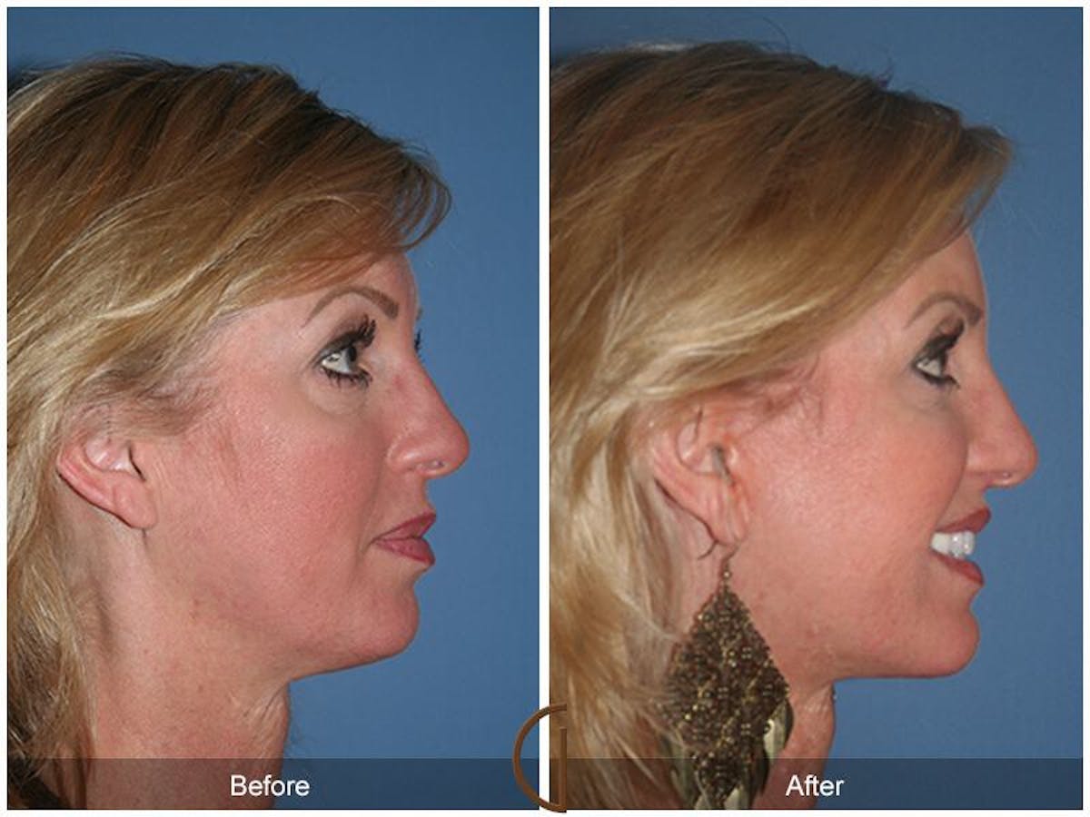 Facelift 40s Before & After Gallery - Patient 282750 - Image 3