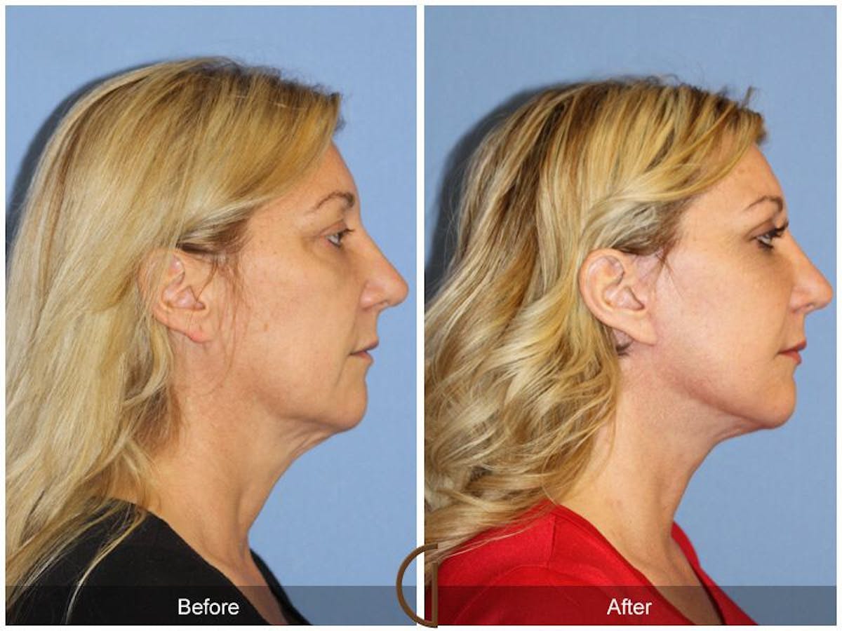 Facelift 40s Before & After Gallery - Patient 859381 - Image 3