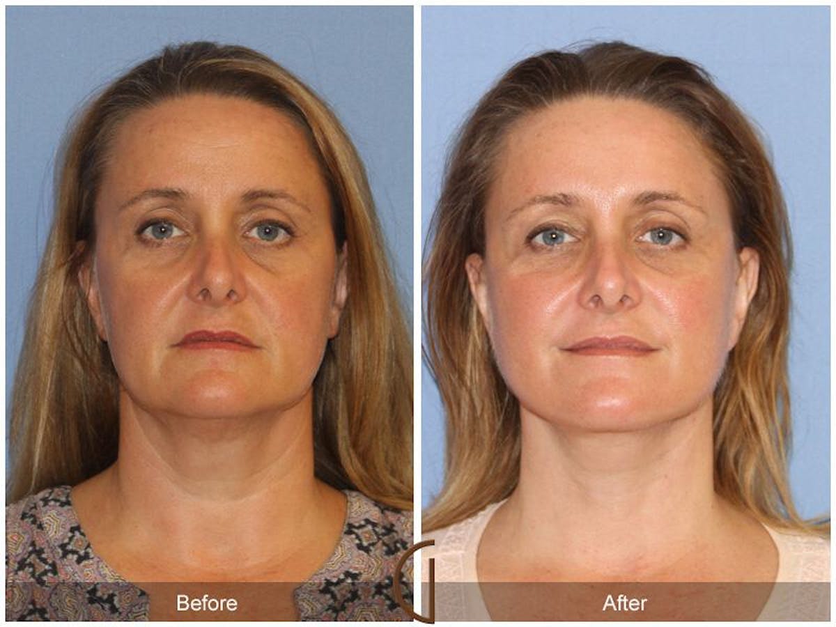 Facelift 40s Before & After Gallery - Patient 315879 - Image 2