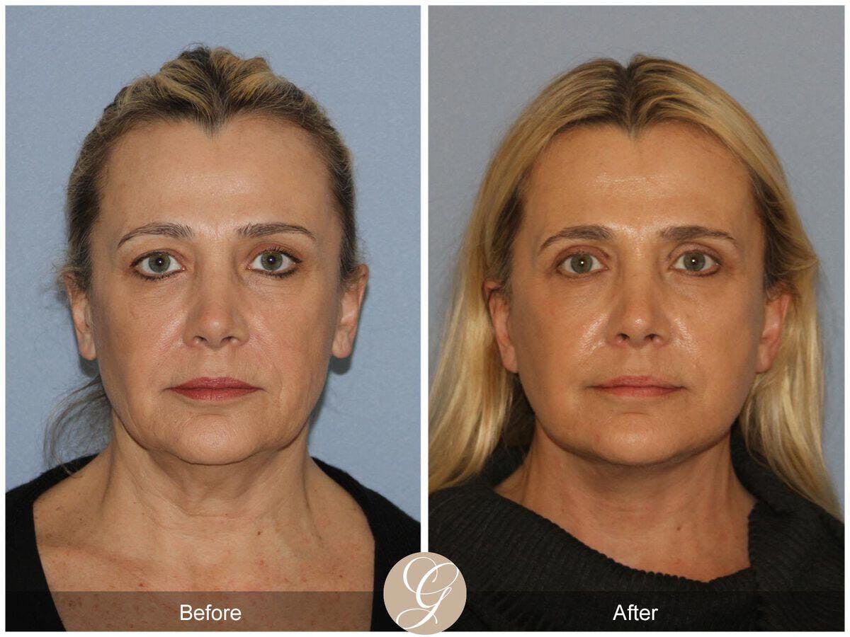 Facelift 40s Before & After Gallery - Patient 114477 - Image 2