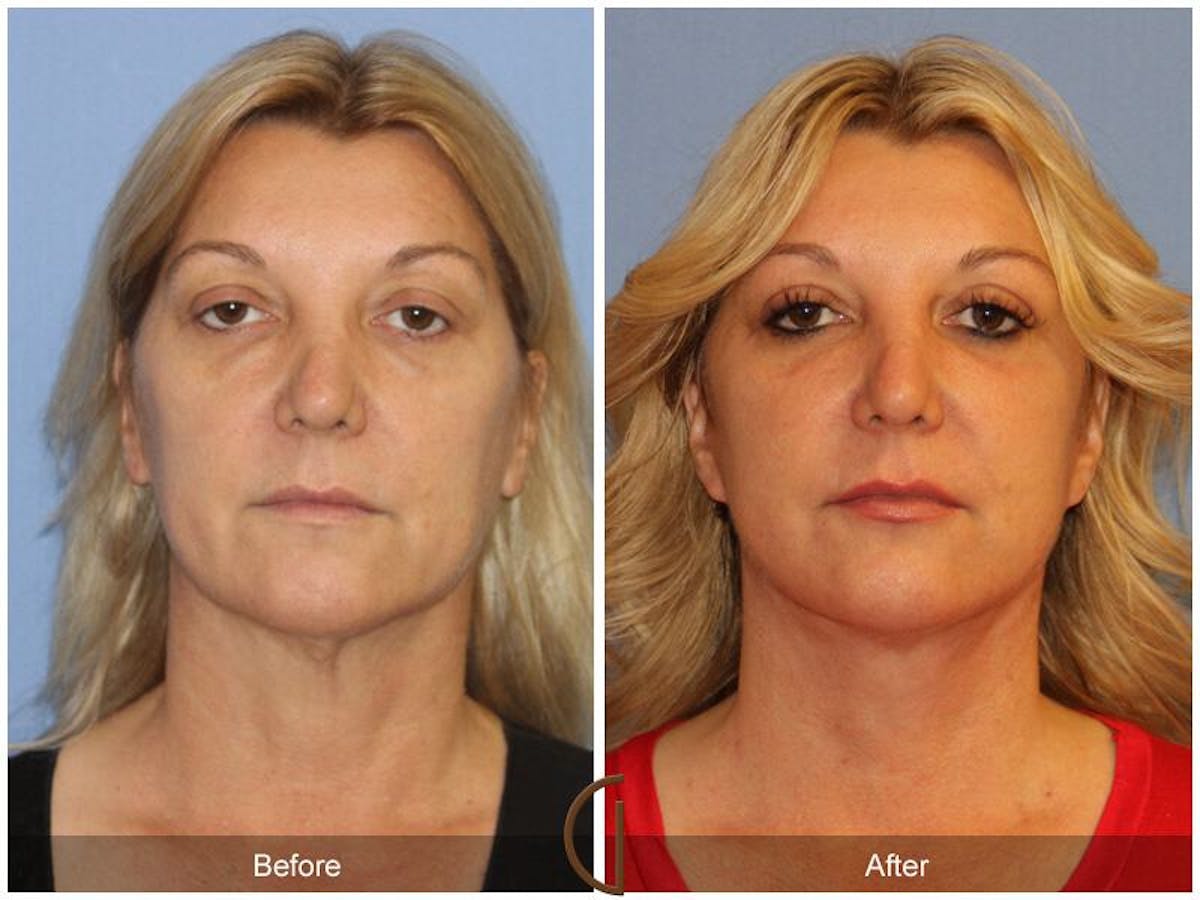 Facelift 40s Before & After Gallery - Patient 859381 - Image 2