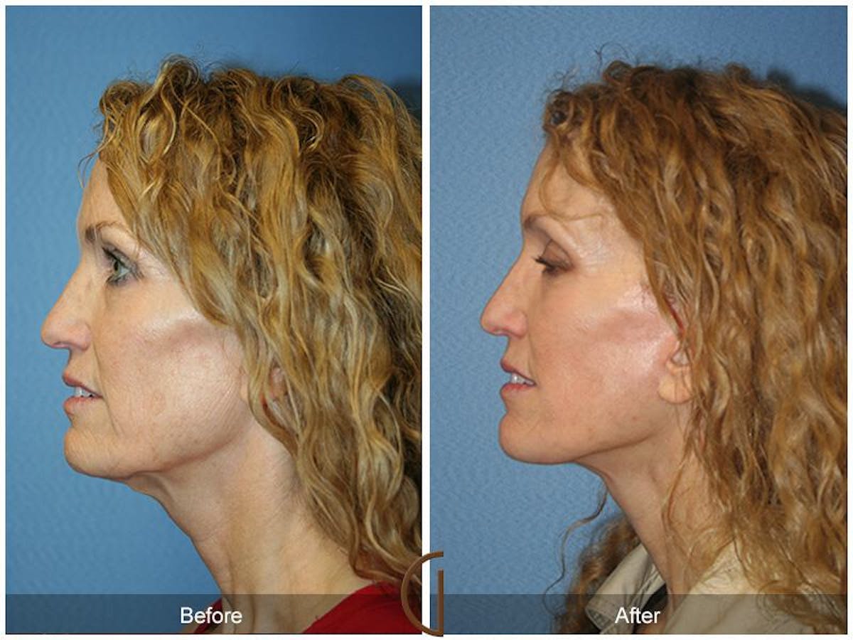 Facelift 40s Before & After Gallery - Patient 162654 - Image 1