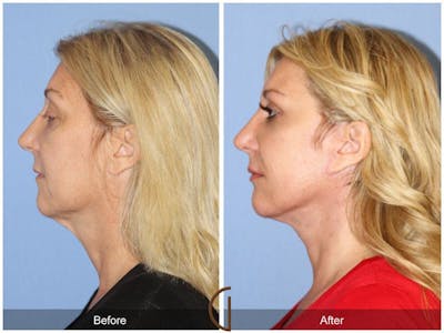 Facelift 40s Before & After Gallery - Patient 859381 - Image 1