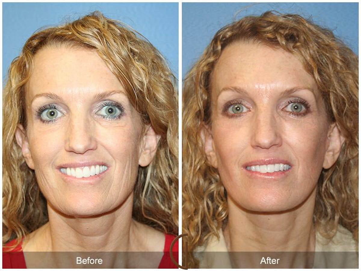 Facelift 40s Before & After Gallery - Patient 162654 - Image 2