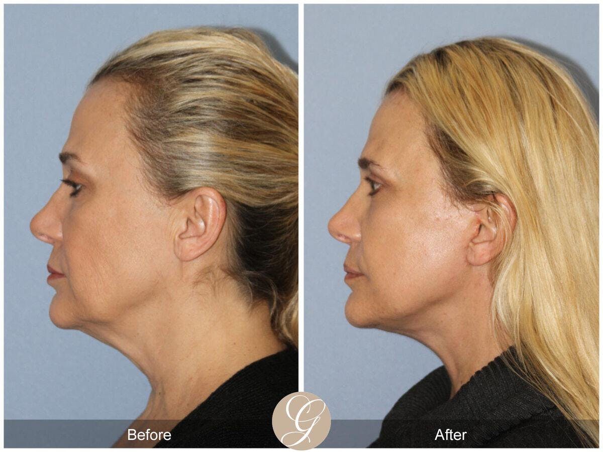 Facelift 40s Before & After Gallery - Patient 114477 - Image 1
