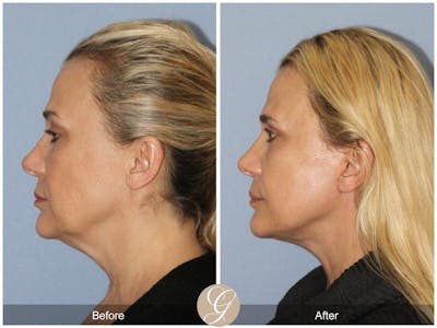 Facelift 40s Before & After Gallery - Patient 114477 - Image 1