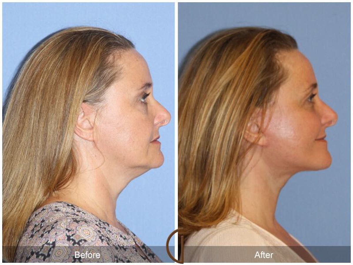 Facelift 40s Before & After Gallery - Patient 315879 - Image 3