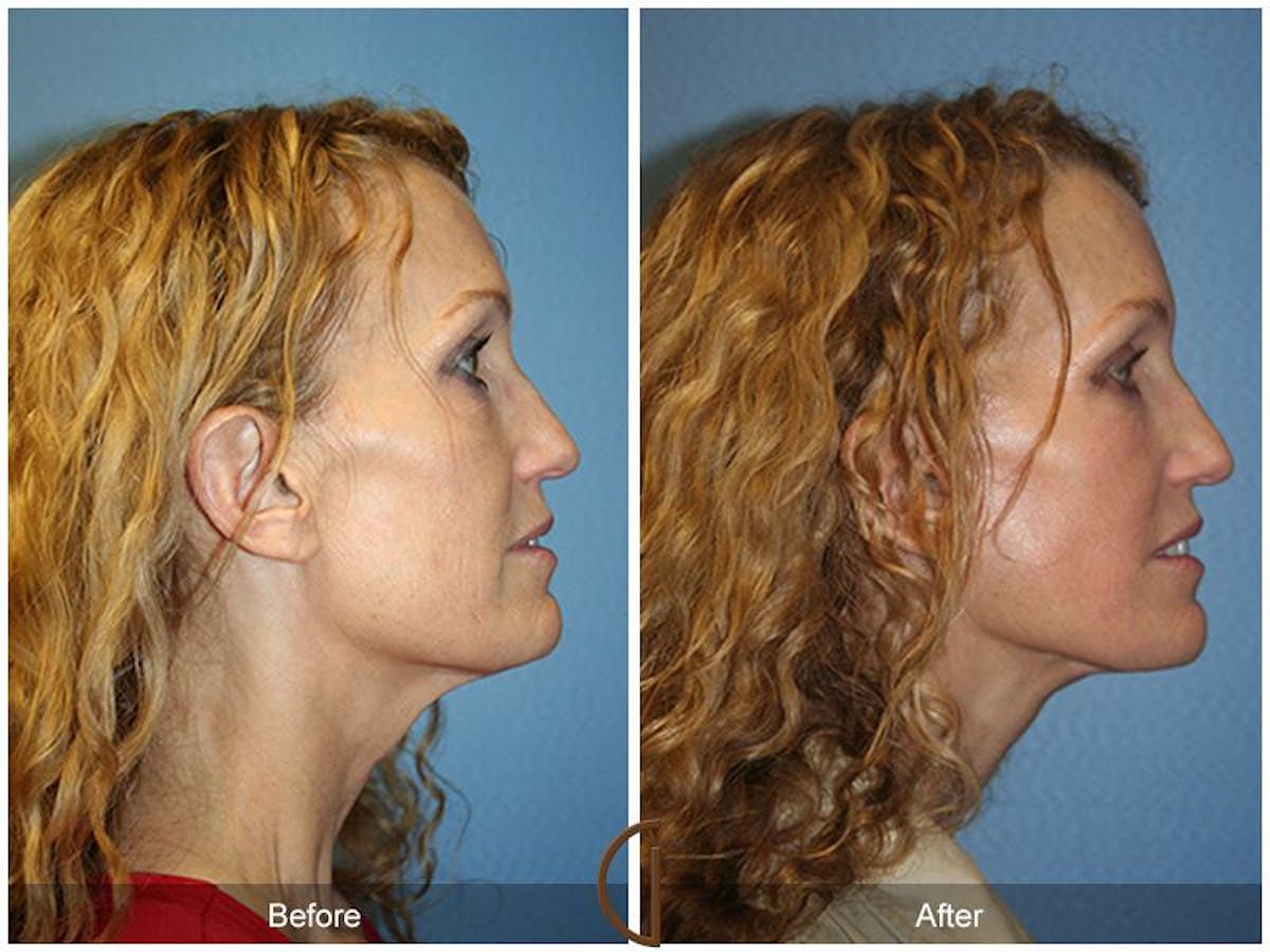 Facelift 40s Before & After Gallery - Patient 162654 - Image 3