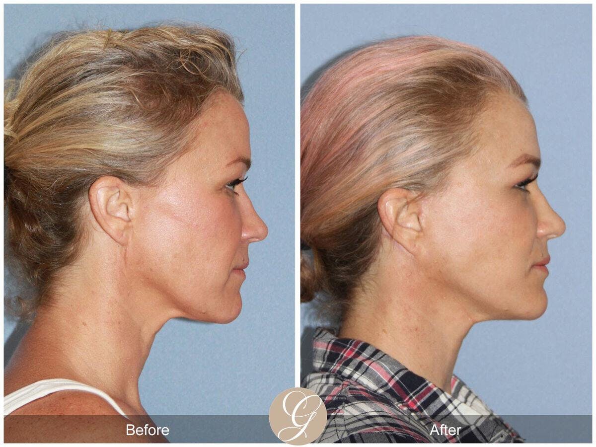 Facelift 40s Before & After Gallery - Patient 386285 - Image 3