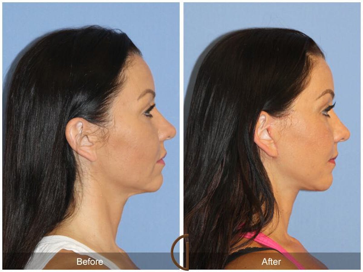 Facelift 40s Before & After Gallery - Patient 108461 - Image 3
