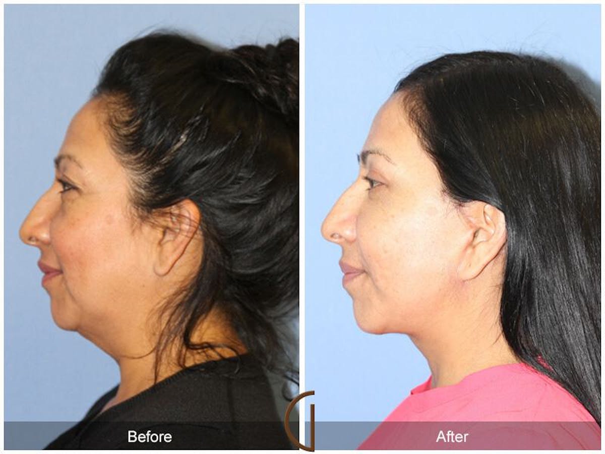 Facelift 40s Before & After Gallery - Patient 383907 - Image 1