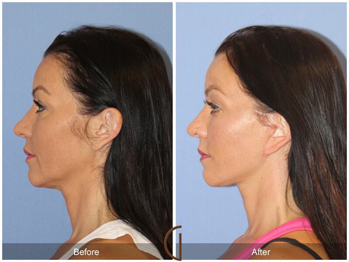 Facelift 40s Before & After Gallery - Patient 108461 - Image 1