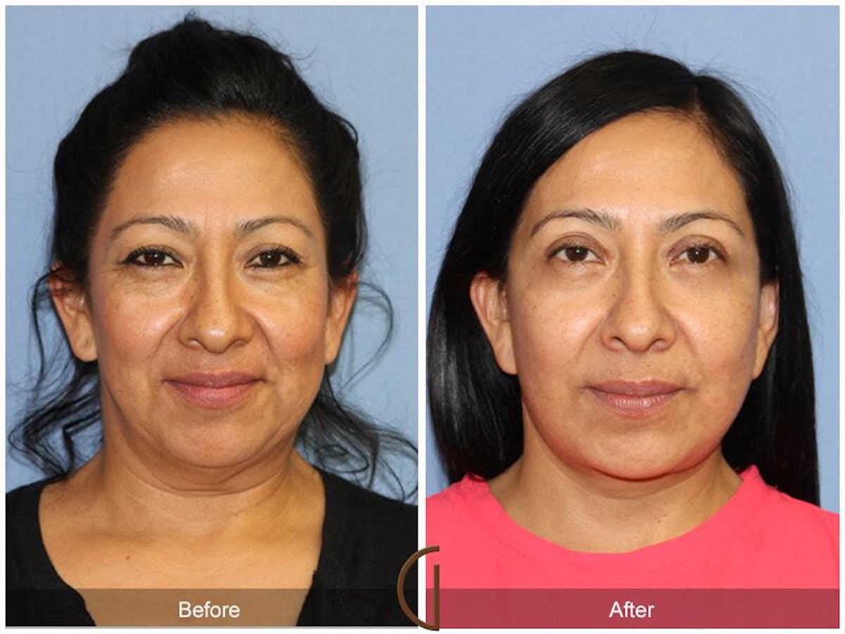 Facelift 40s Before & After Gallery - Patient 383907 - Image 2